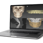 Chirurgia guidata e impianti iuxtaossei: cosa offre al clinico la nuova implantologia digitale