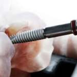 Tecniche di chirurgia implantare, un confronto tra principianti ed esperti