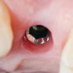 Perdita ossea marginale e perimplantite, tra vecchie e nuove teorie