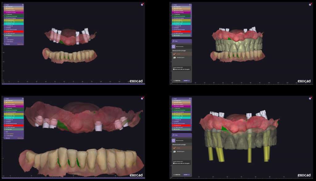 progetto digitale full-arch