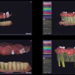 Progetto digitale full-arch eseguito con chirurgie multiple progetto digitale full-arch