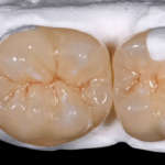 Riabilitazione degli elementi diatorici con tecniche adesive metal free