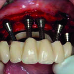 Terapia fotodinamica e riabilitazione a carico immediato: sì alla decontaminazione!