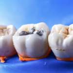 Restauri in amalgama e composito, quanto resistono alla frattura