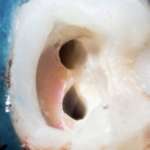 Silicato di calcio, gli effetti sul trattamento endodontico