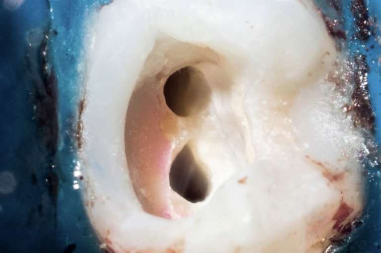 Silicato di calcio, gli effetti sul trattamento endodontico