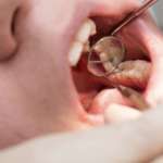 Carie occlusale, rilevabile anche sulle immagini 3D