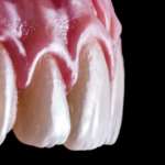 Le gengive molli sono più soggette all’infiammazione