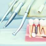 Malattie perimplantari e prevenzione, si può fare di più