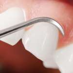 Difetti papillari interdentali: quanto è efficace l’acido ialuronico