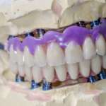 Protesi fissa, allontana il decadimento cognitivo