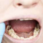 Terapia endodontica rigenerativa, un caso clinico documentato