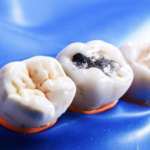 Materiali bioattivi: il futuro dell’odontoiatria restaurativa