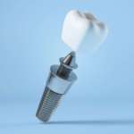 Impianto pterigoideo, come determinarne la lunghezza ottimale