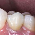 I materiali da restauro con effetti antibatterici