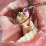 Procedure endodontiche rigenerative: nuove opportunità per i denti compromessi