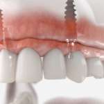 Mascellari atrofici, rialzo del seno e impianto in una volta sola