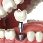 Impianto danneggiato: un nuovo metodo per recuperarlo