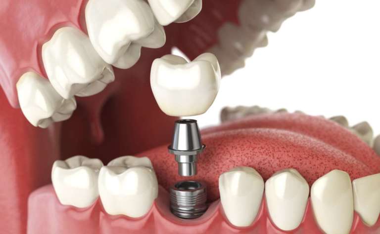 Impianto danneggiato: un nuovo metodo per recuperarlo