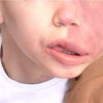 Manifestazioni orali e gestione clinica nei pazienti affetti da sindrome di Sturge Weber Sindrome di Sturge Weber