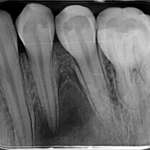 Prestazioni cliniche dei cementi bioceramici: una revisione della letteratura