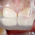 Tecnica ibrida di preparazione osteotomica