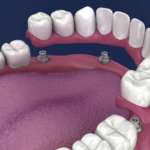 Overdenture su impianti, uno studio ne indaga il tasso di successo
