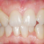 Ortodonzia linguale 2D e terapia estrattiva asimmetrica Ortodonzia linguale