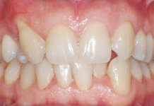 Ortodonzia linguale 2D e terapia estrattiva asimmetrica Ortodonzia linguale