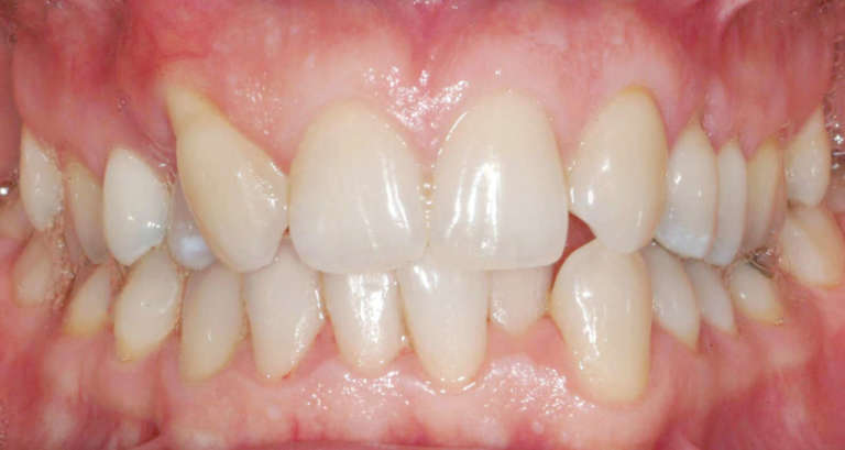 Ortodonzia linguale 2D e terapia estrattiva asimmetrica