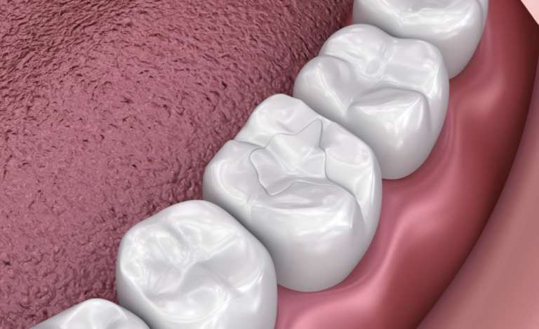 Adesivo universale sperimentale, uno studio sugli effetti della viscosità