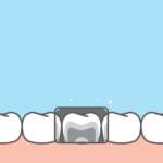 Radiografie bite-wing: scatti vincenti verso il traguardo della prevenzione