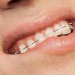 Trattamento ortodontico e DTM, esiste una correlazione