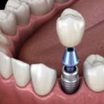 Uno studio sulle corone ibride “abutment” monolitiche in disilicato di litio