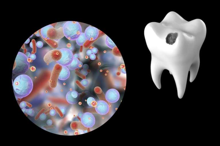 Selenomonas sputigena è tra le possibili cause della carie