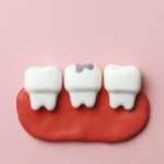 Fluoruro di diammina d’argento, come agisce sulle lesioni cariose