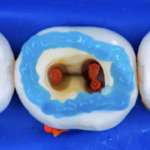 La chiave del successo in endodonzia