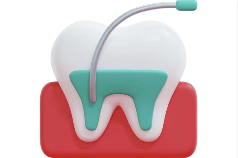 Endodonzia: irrigazione e dolore post-operatorio, metodi vecchi e nuovi a confronto