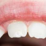 Incisivi immaturi traumatizzati, i risultati di un trattamento endodontico