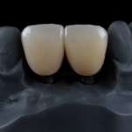 Restauri in zirconia, due diversi cementi a confronto