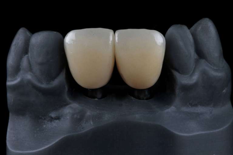 Restauri in zirconia, due diversi cementi a confronto