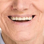 La riabilitazione dei pazienti edentuli