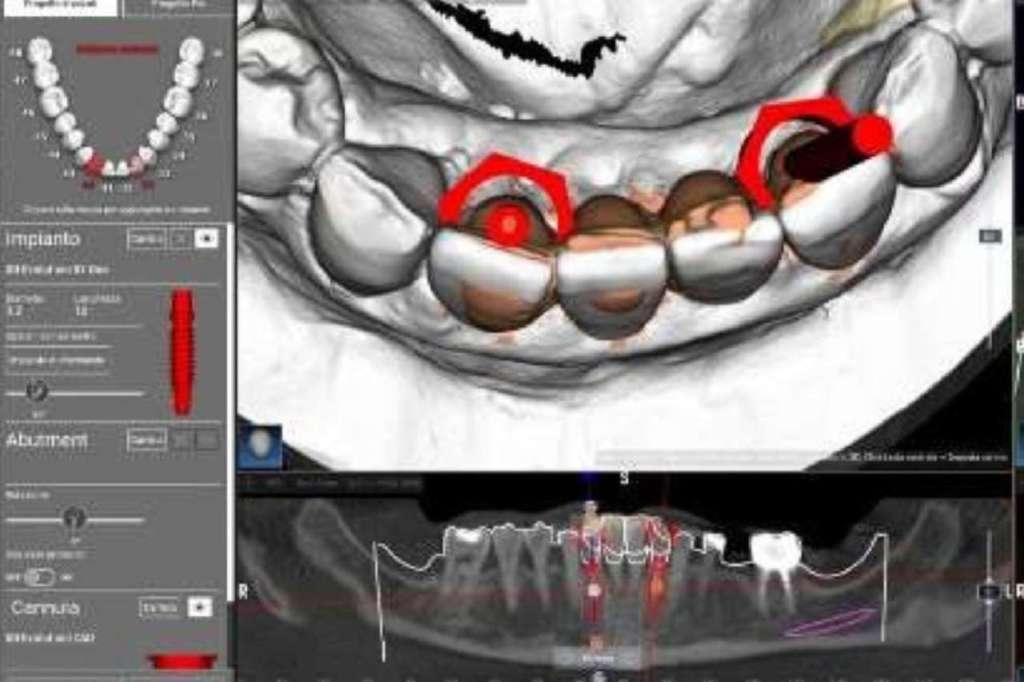 disparallelismi implantari