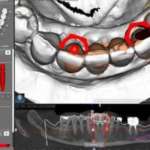 Protesizzazione diretta e correzione di disparallelismi implantari senza impiego di meso-strutture disparallelismi implantari