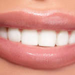 Criteri di scelta del materiale per le faccette