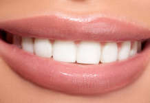 Criteri di scelta del materiale per le faccette