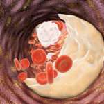 Terapia antitrombotica, la gestione perioperatoria in studio