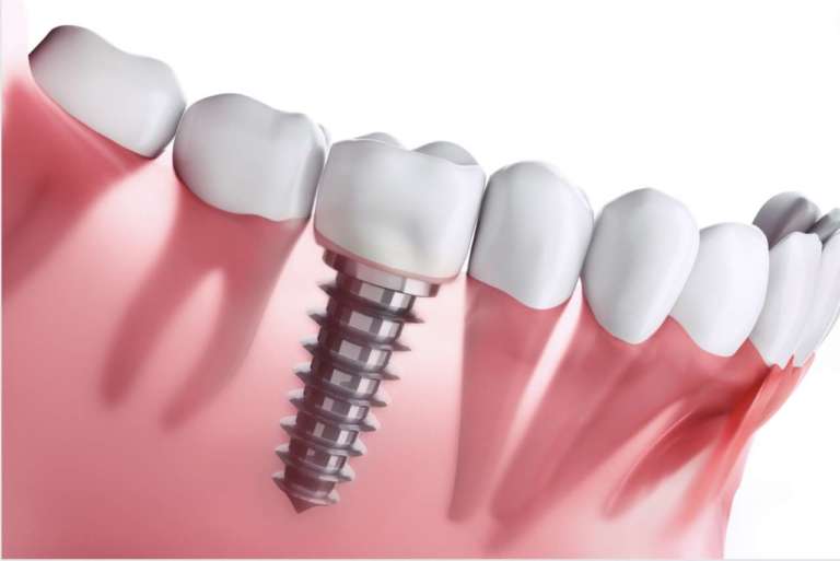 Impianti dentali, gli effetti su denti e tessuti adiacenti