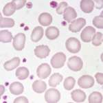 Rigenerazione pulpare, il ruolo dei concentrati di piastrine