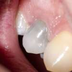 Pulpite irreversibile nei soggetti con storia di COVID-19